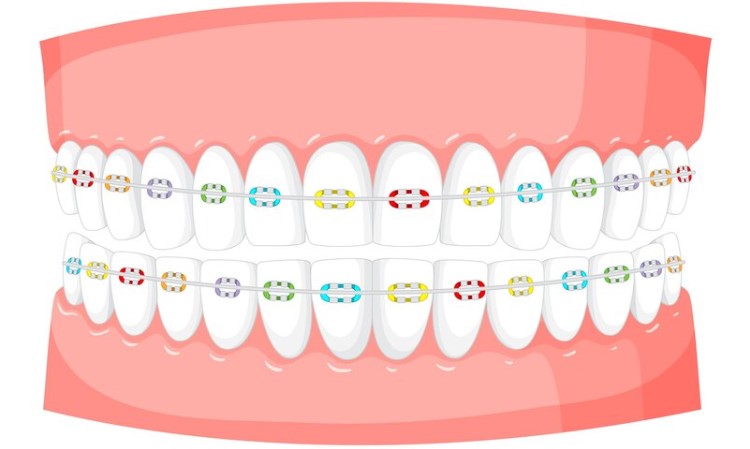 Braces in Arlington