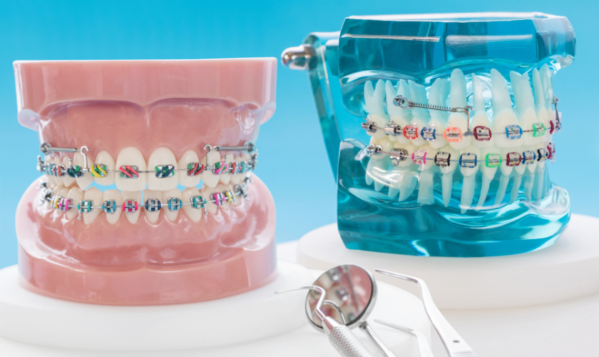 Braces arlington