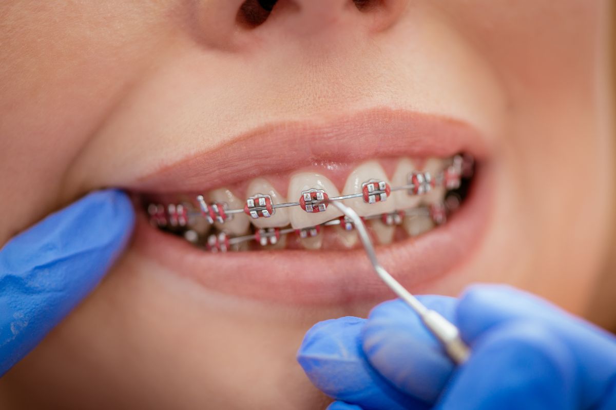 Benefits of Braces