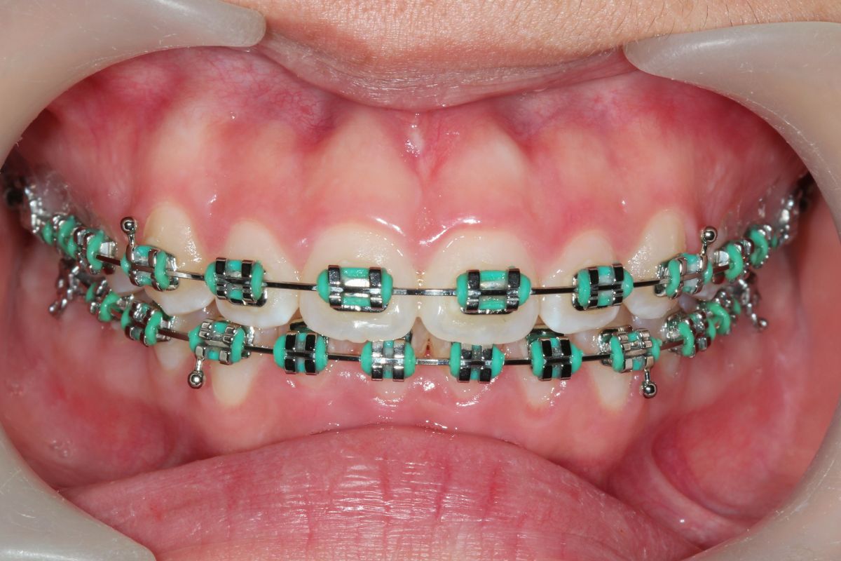 orthodontic treatment