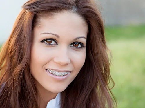 Clear Aligners