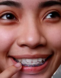 ortho-bottom-braces