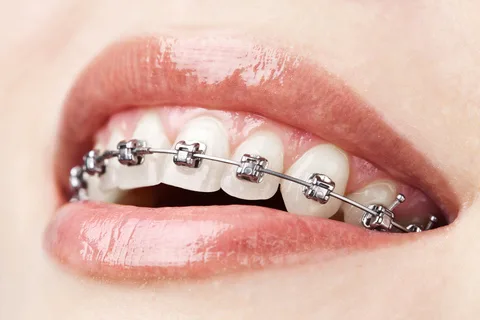 wpid-ortho-helpful-site-braces