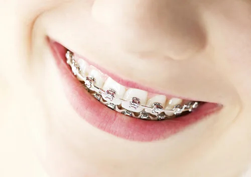 Close-up of smiling mouth displaying metal braces on upper teeth against neutral background.