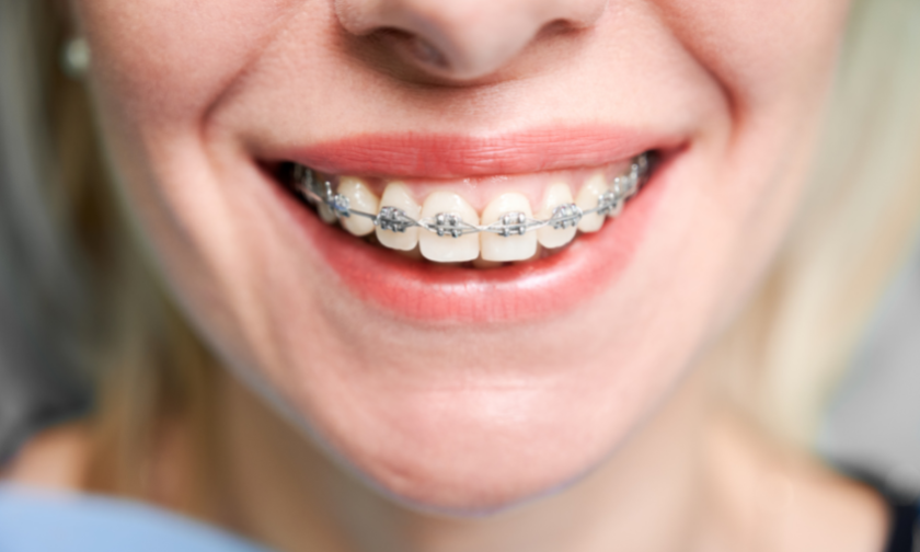 Types Of Braces