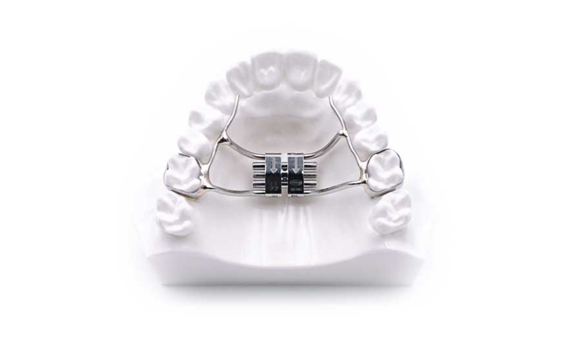 What Is a Palatal Expander & What Is Their Purpose (1)