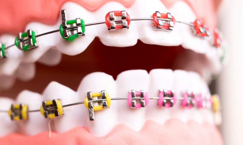 Braces Arlington