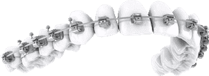 Orthodontic braces progression showing clear aligners and metal brackets arranged in a curved sequence.