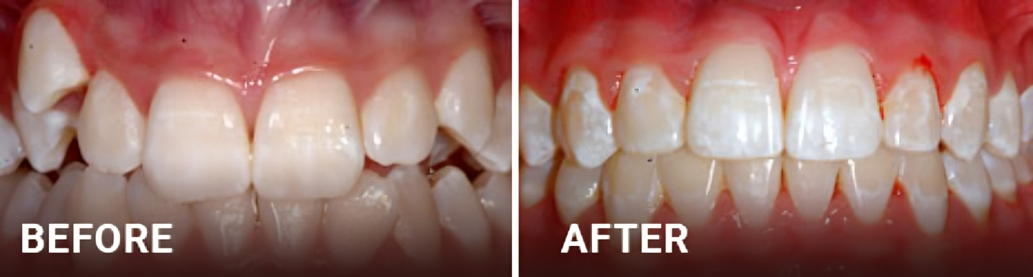 Before and after dental alignment comparison showing straightened teeth results from orthodontic treatment.