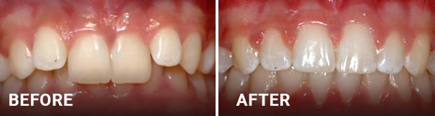 Before and after orthodontic treatment showing dental alignment improvement and tooth straightening results.