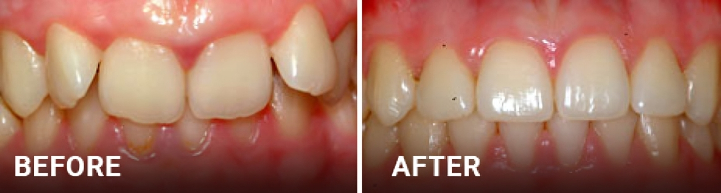 Before and after dental treatment showing improved tooth alignment and whiteness by Hildebrand Orthodontics.