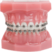 Dental model displaying metal braces on teeth with pink gums and case.