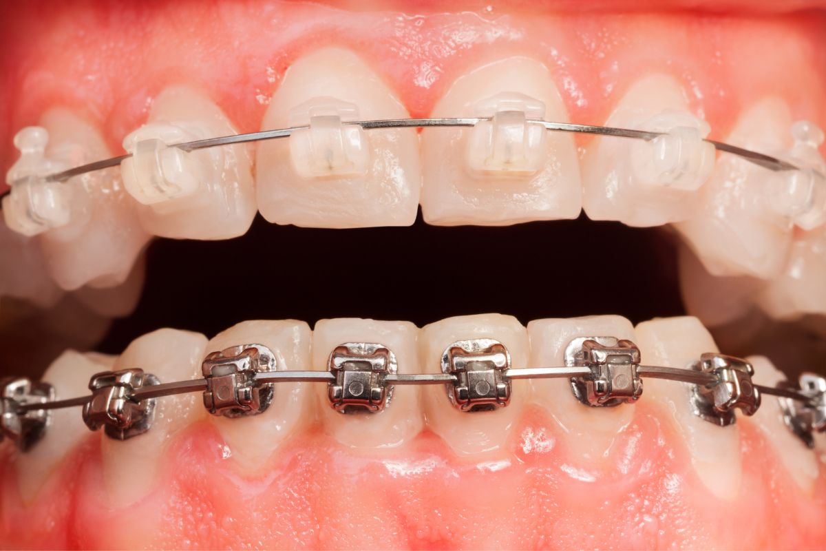 Braces Move My Teeth