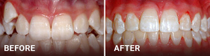 Before and after dental treatment showing improved tooth alignment and whiteness from orthodontic care.
