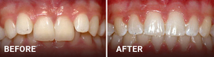 Before and after orthodontic treatment showing improved tooth alignment and spacing.