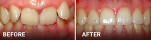 Before and after dental treatment showing improved tooth alignment and appearance.