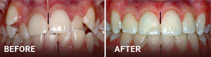 Dental before and after comparison showing teeth alignment treatment results from orthodontics