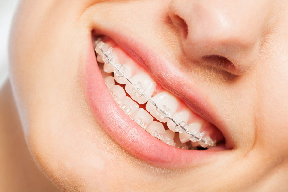 Close-up of person smiling, displaying teeth with orthodontic braces in clinical setting.