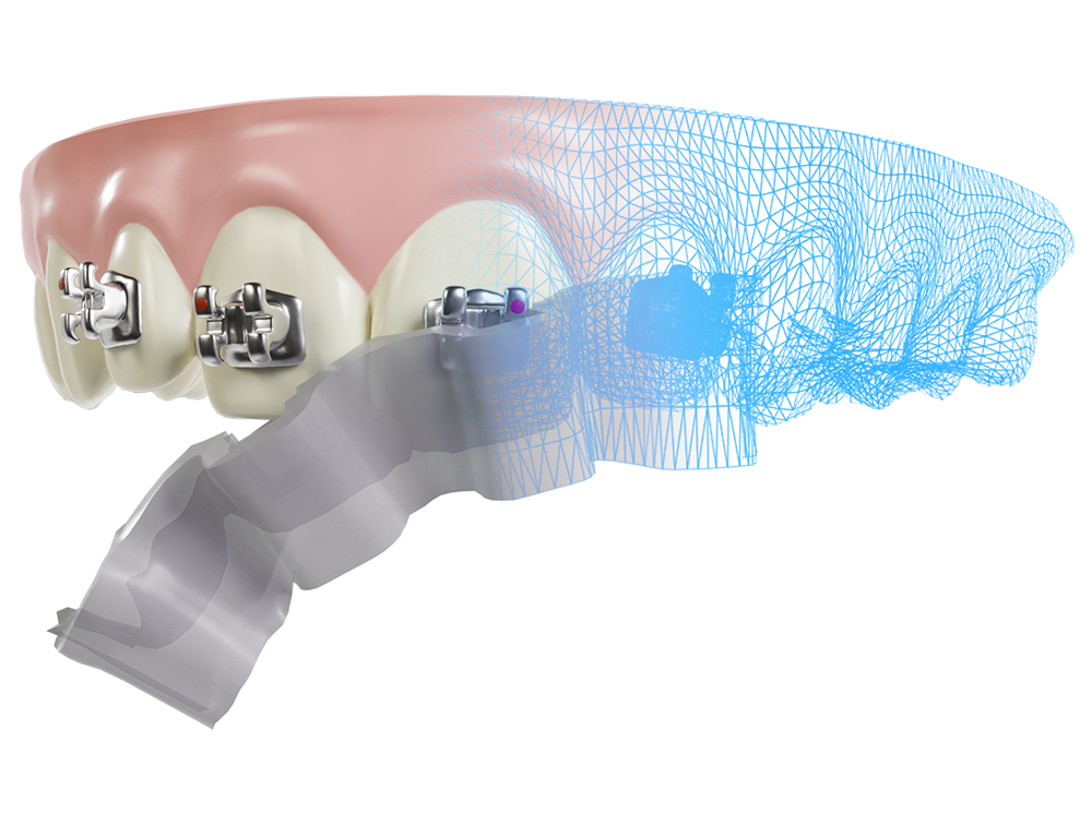 Orthodontic appliance showing dental brackets attached to transparent teeth model with blue elastic components.