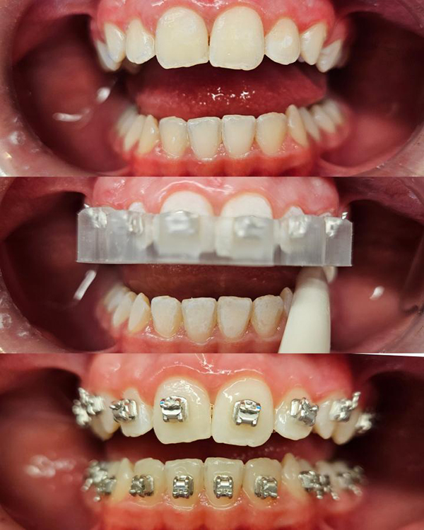 Three-panel orthodontic treatment progression showing teeth alignment from natural state through clear aligner to metal braces.