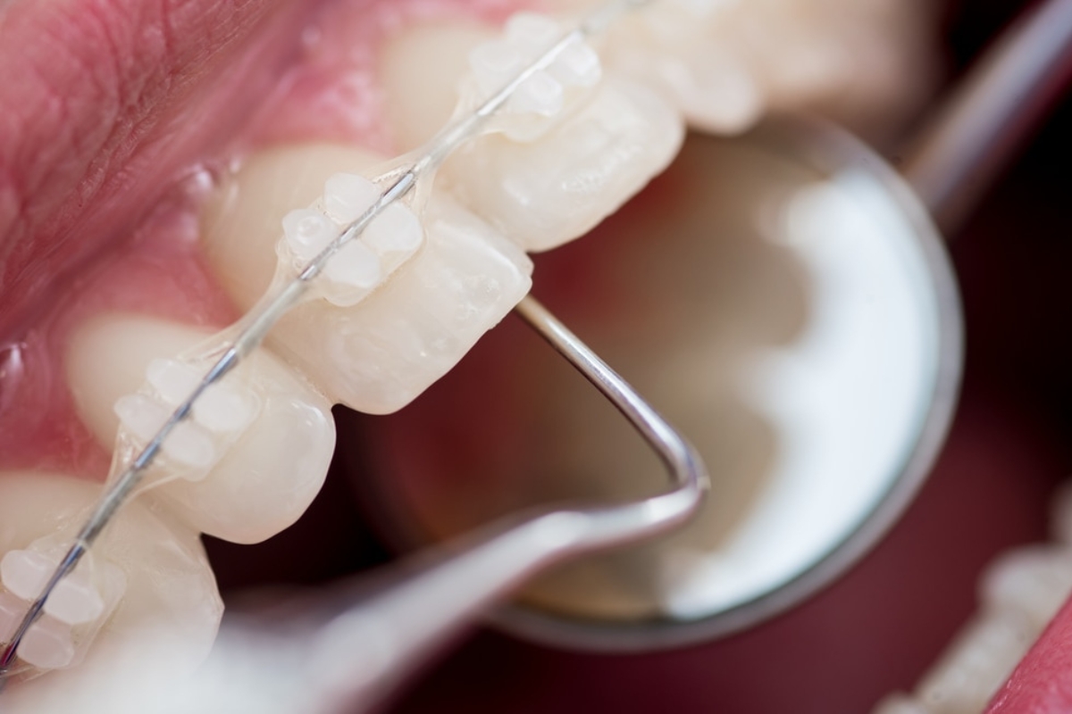 clear braces of a Arlington patient