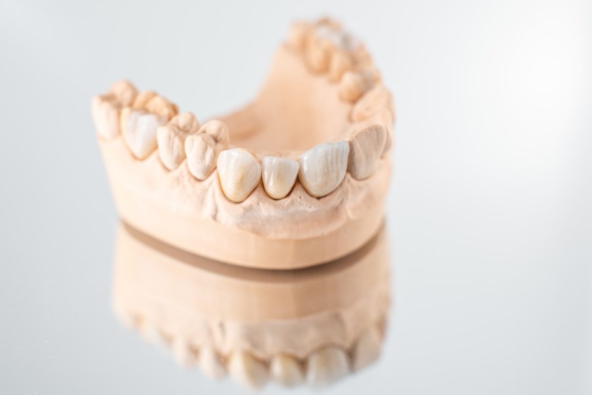 Dental model showing upper and lower teeth arrangement for orthodontic treatment planning and visualization.