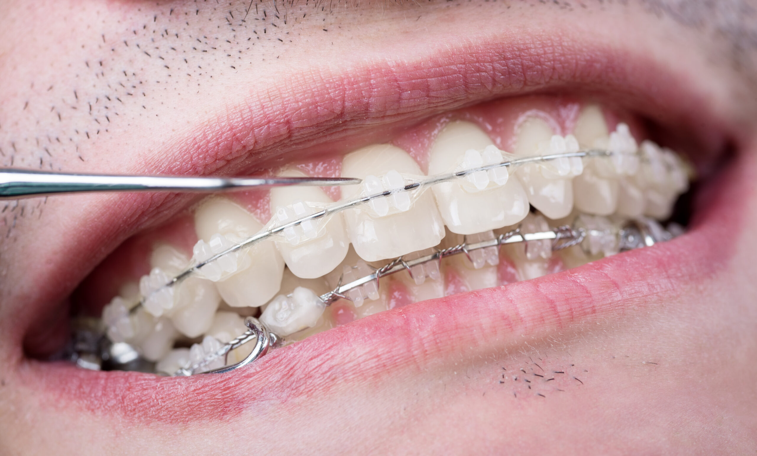 Close-up of person wearing clear aligners on upper teeth during orthodontic treatment.