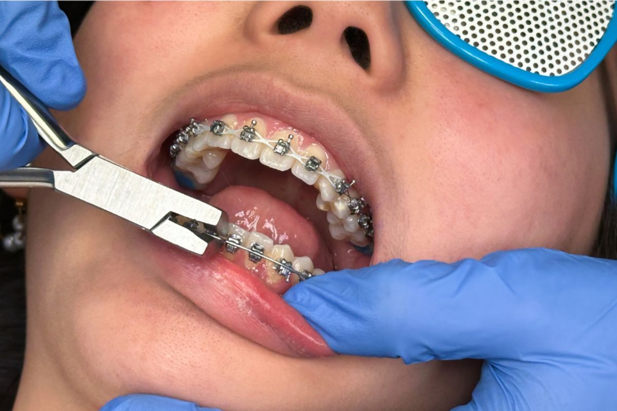 Orthodontist adjusting clear braces on patient's lower teeth during bite correction treatment.